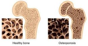 Osteoporosis tulang